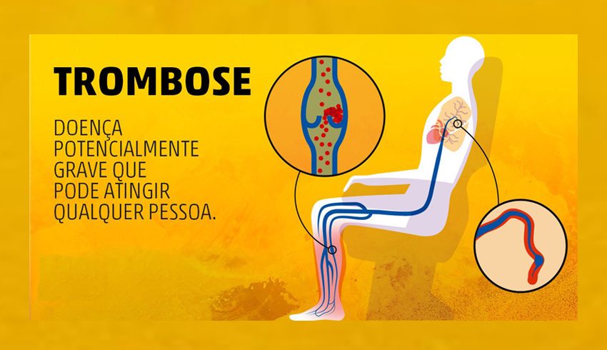  Mitos e verdades sobre a Trombose